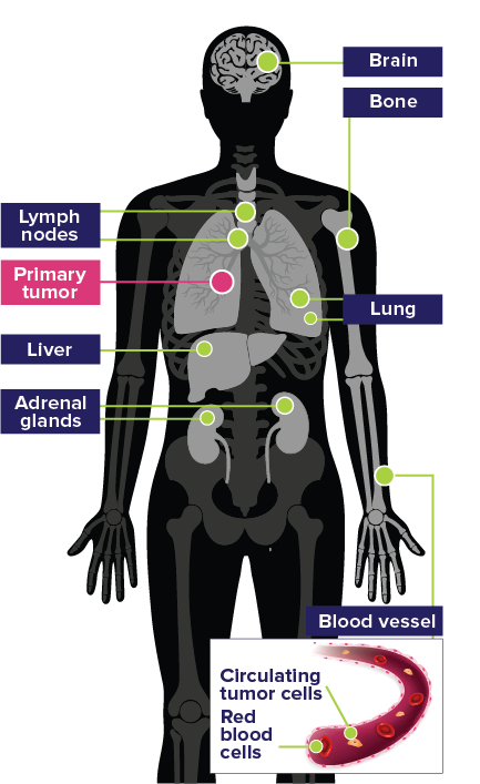 Common Sites of Metastases in Small Cell Lung Cancer (SCLC) Diagram