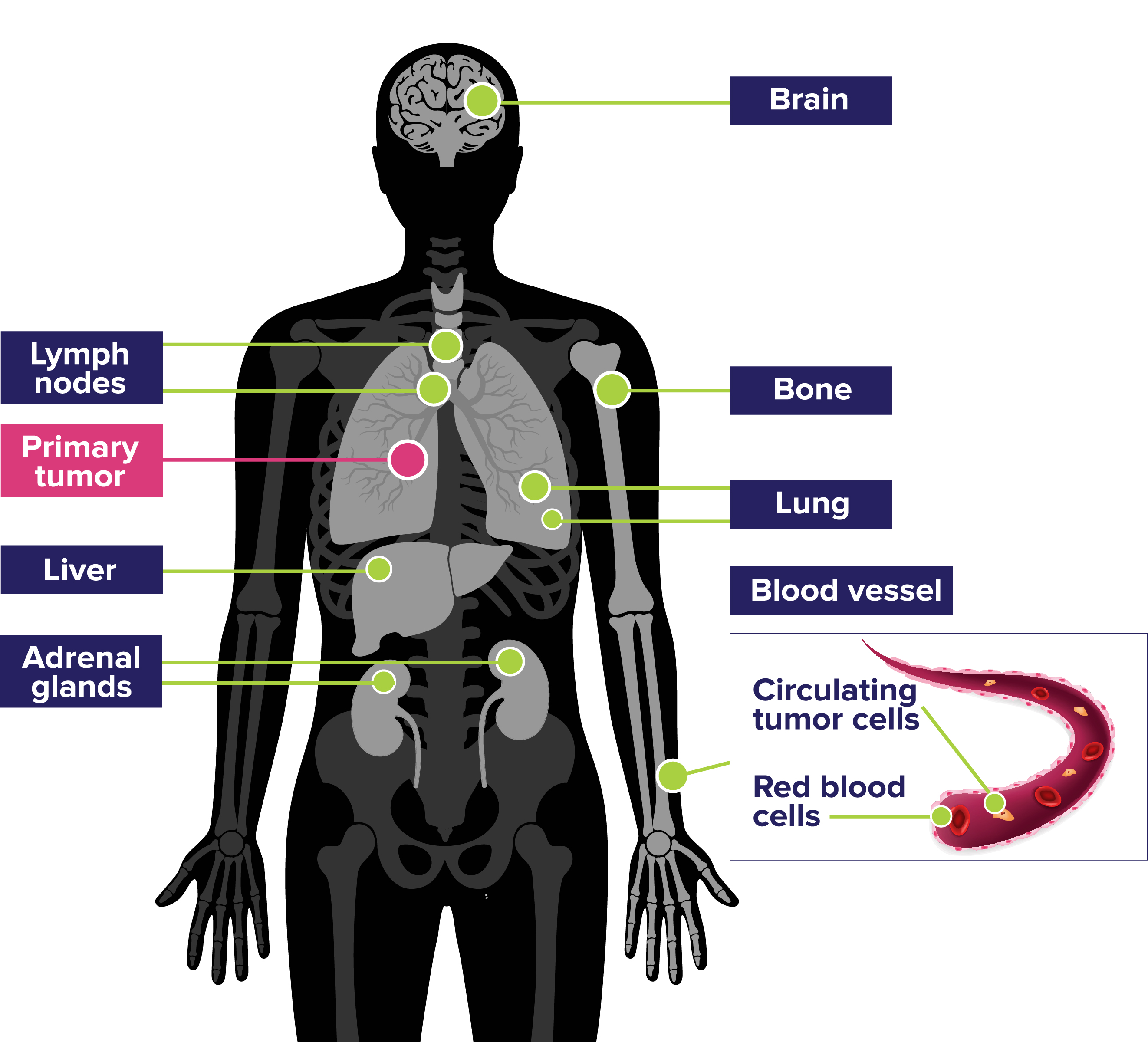 Common Sites of Metastases in Small Cell Lung Cancer (SCLC) Diagram