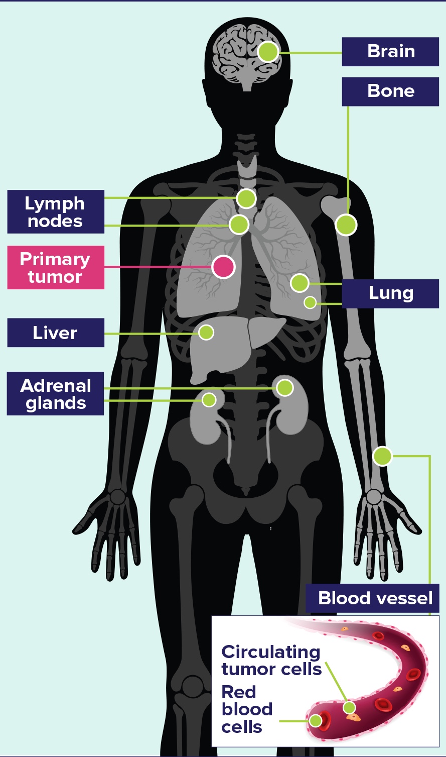 Common Sites of Metastases in Small Cell Lung Cancer (SCLC) Diagram