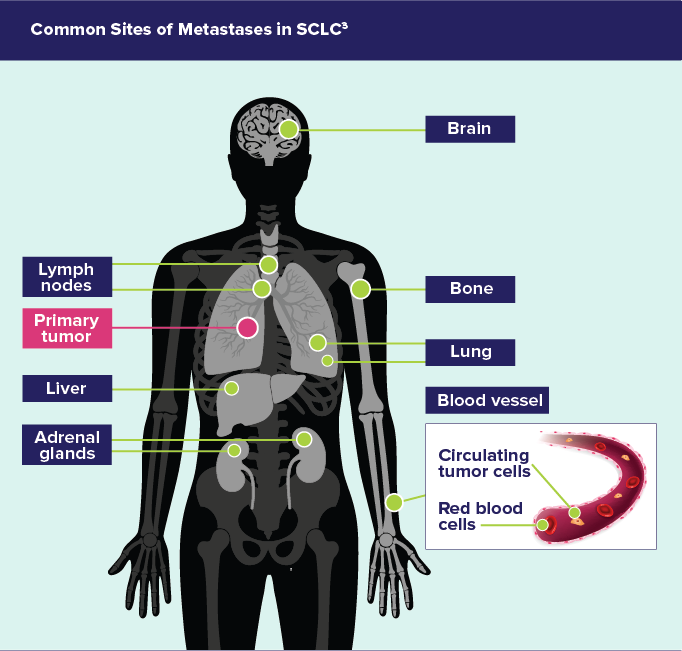 Common Sites of Metastases in Small Cell Lung Cancer (SCLC) Diagram