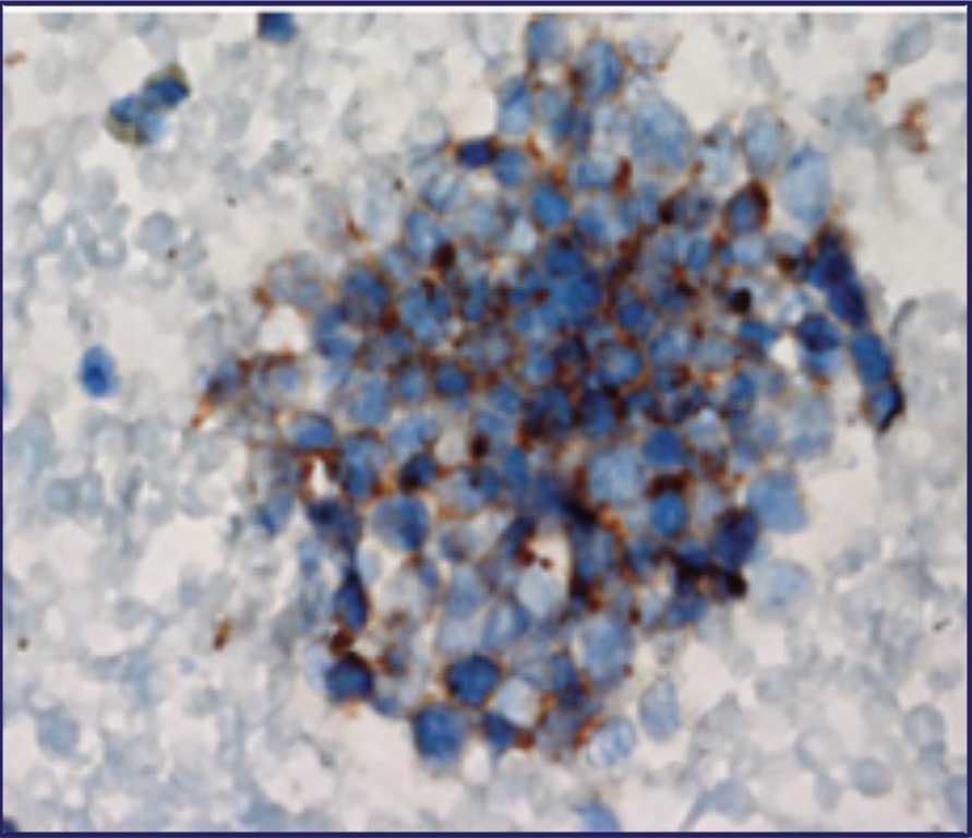 Small Cell Lung Cancer (SCLC) Tumor Cells Close Up