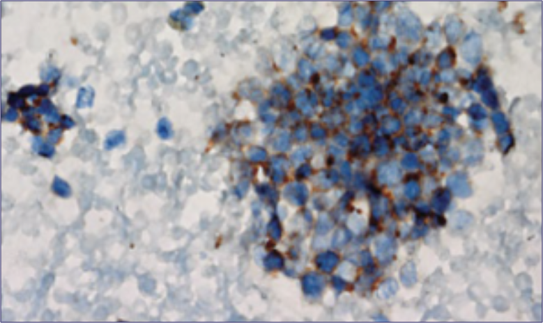 Small Cell Lung Cancer (SCLC) Tumor Cells Close Up